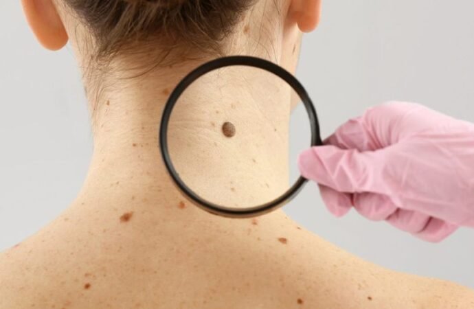 Mediante la IA detectarán a tiempo cáncer de piel